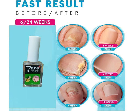 7 Days Nail Fungus Treatement Polish