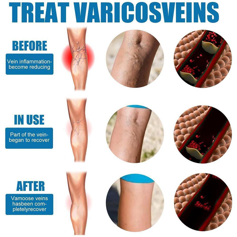 Varicose Veins Treatment Spray