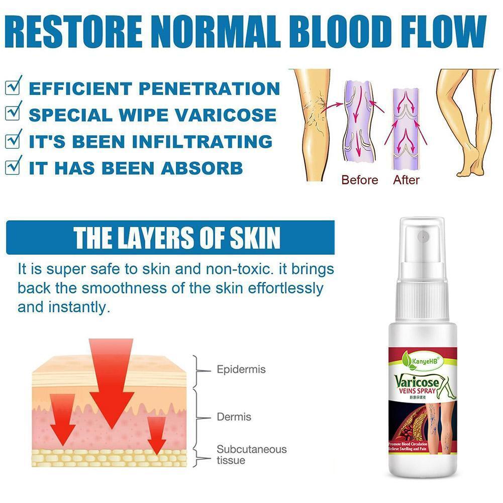 Varicose Veins Treatment Spray