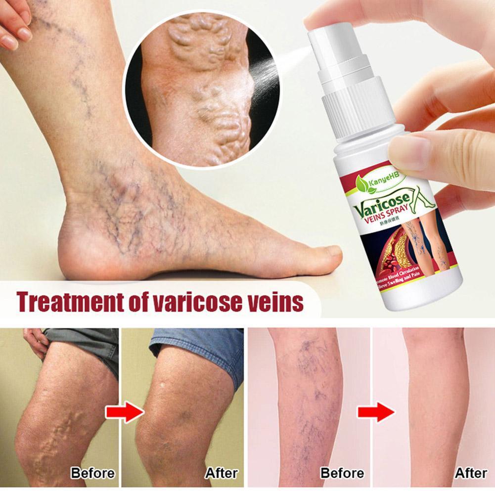 Varicose Veins Treatment Spray