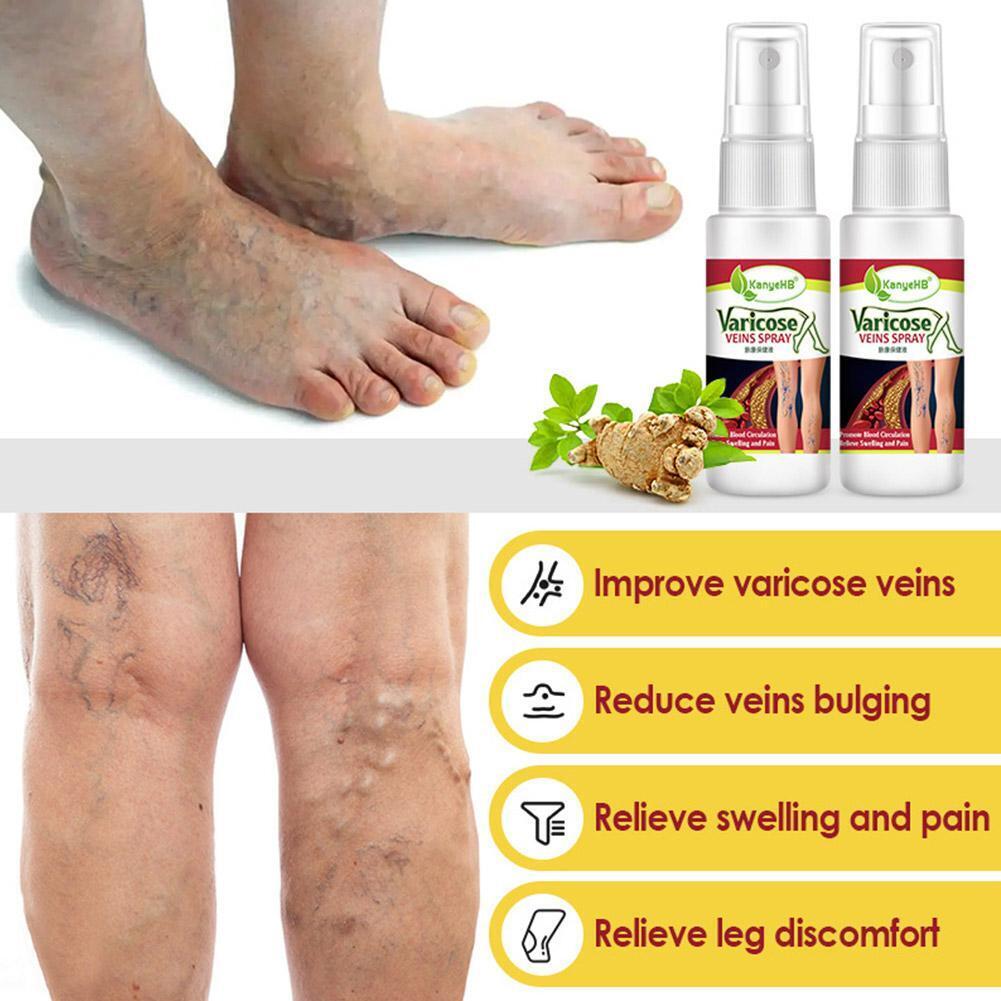 Varicose Veins Treatment Spray